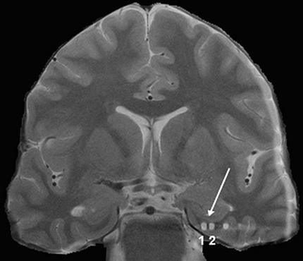 Alzheimers Stimulation Strengthen Memory